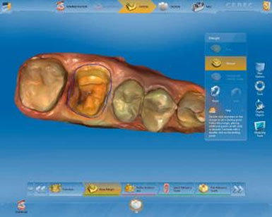 CEREC AC OMNICAM ПРОСТОЕ СКАНИРОВАНИЕ БЕЗ АНТИБЛИКОВОГО СПРЕЯ 11.jpg
