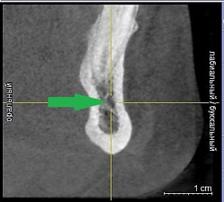 Рисунок 1b- КЛКТ. Коронарныи реформат нижнеи челюсти в переднем отделе. (Зеленая стрелка резцовая петля).jpg Рисунок 1b- КЛКТ. Коронарныи реформат нижнеи челюсти в переднем отделе. (Зеленая стрелка резцовая петля).jpg