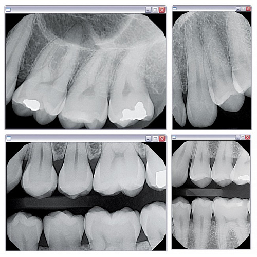 KaVo Gendex GXS-700 - система компьютерной радиовизиографии (сенсор №1)
