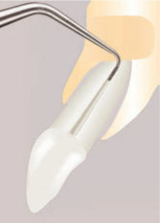 Acteon AS3D – Насадка с алмазным покрытием