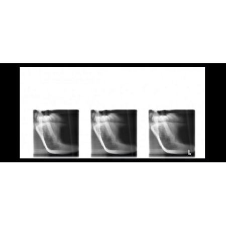 Planmeca ProOne - универсальный цифровой ортопантомограф