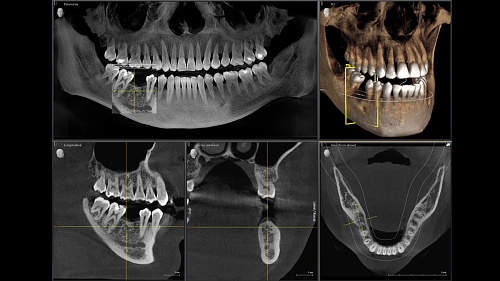 Sirona Orthophos SL 3D (11x10) – Дентальный томограф